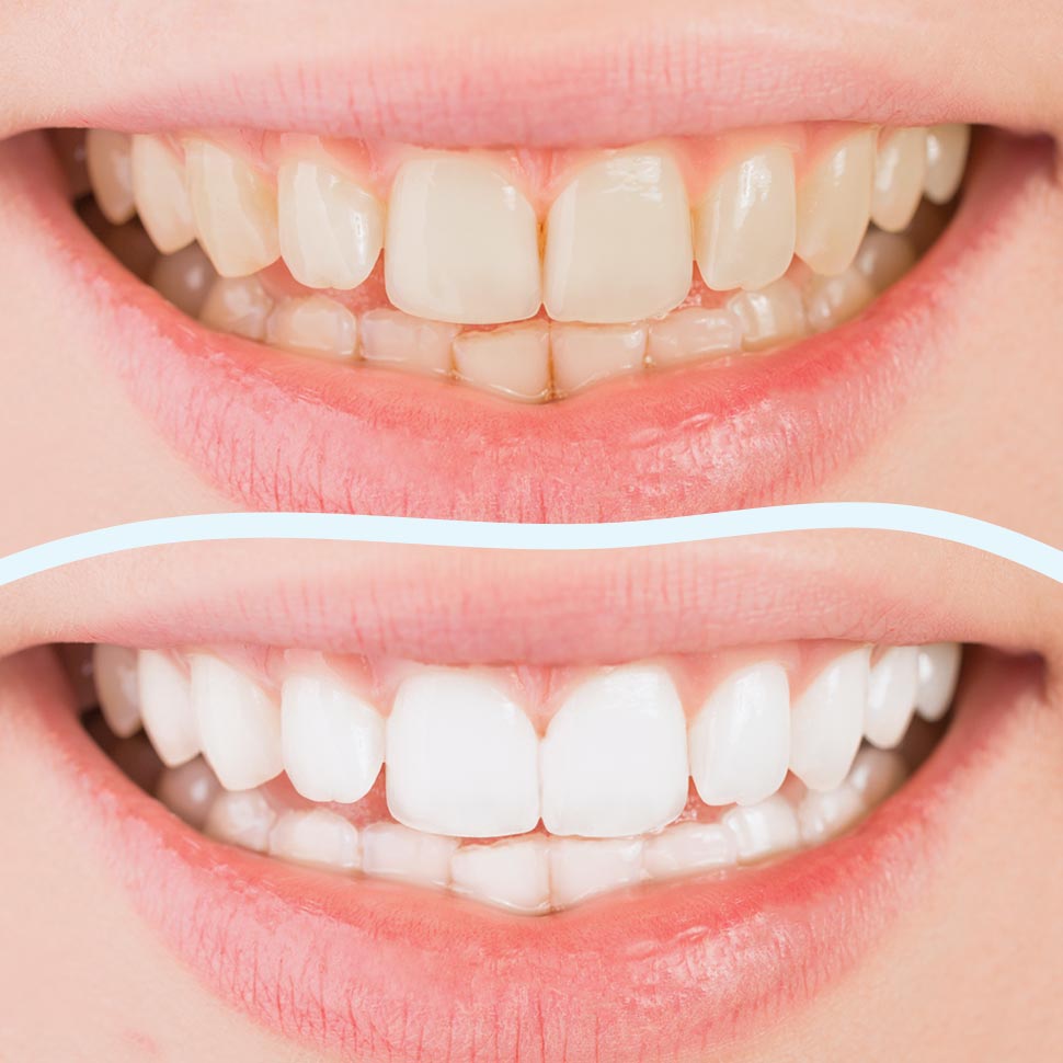 Sorridi all’estete: con lo sbiancamento dentale professionale avrai in omaggio una seduta di igiene orale.
